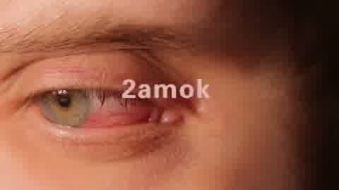 红眼病，红色眼睛，眼睛血丝