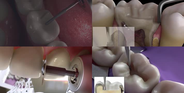 3D牙科手术教学演示 补牙 种植牙