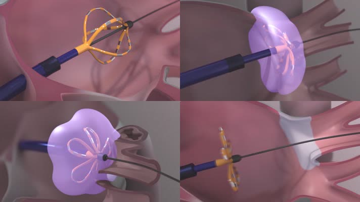 心房颤动消融手术医疗器械动画