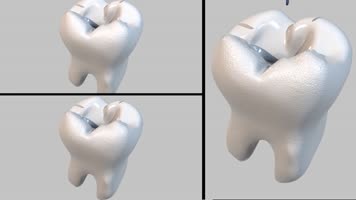 牙科手术三维动画 牙科手术三维动画