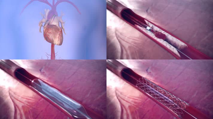 心脏支架手术