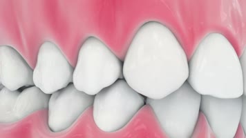牙齿矫正 牙齿矫正