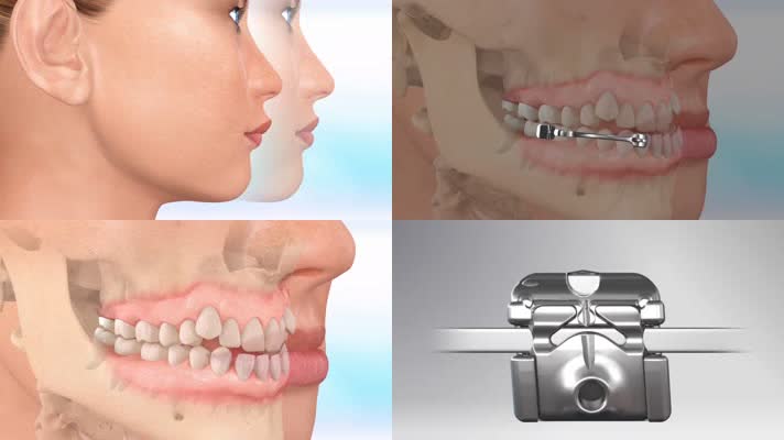 牙齿矫正牙龈矫正