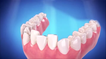 牙齿矫正  牙齿矫正