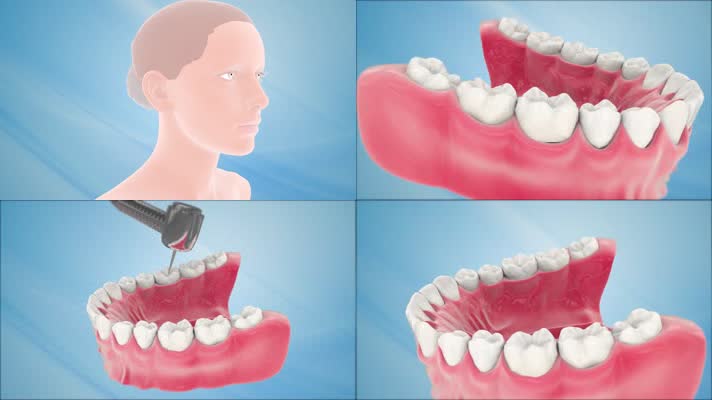 牙齿手术牙齿修复