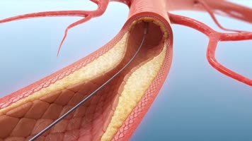 心脏支架血管支架医疗动画