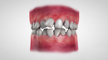 牙齿矫正  牙齿矫正