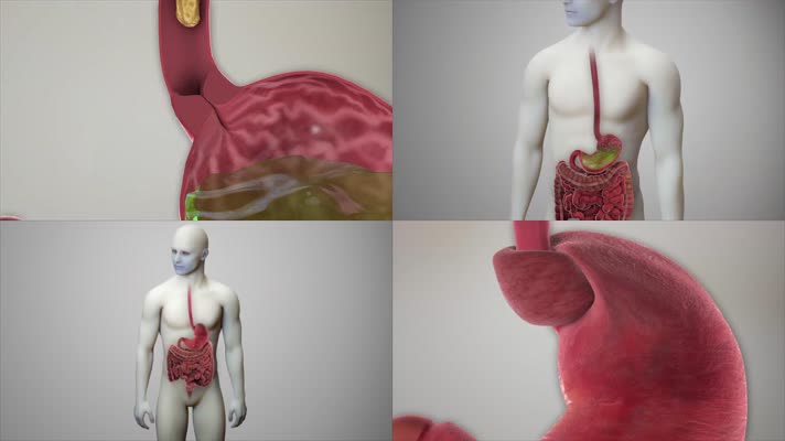 胃底折叠术 胃包扎术治疗反流动画