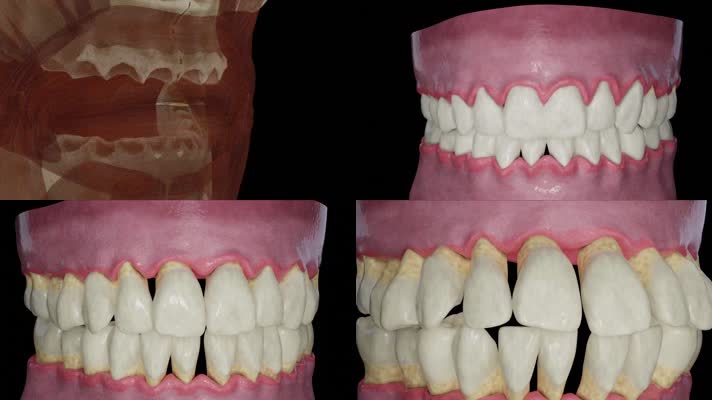 牙龈萎缩牙周病动画