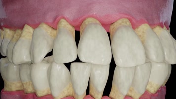 牙龈萎缩牙周病动画 牙龈萎缩牙周病动画