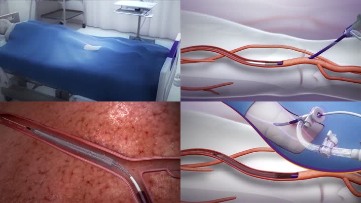 心脏支架搭桥 心脏支架搭桥