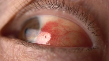 红色眼睛红眼病