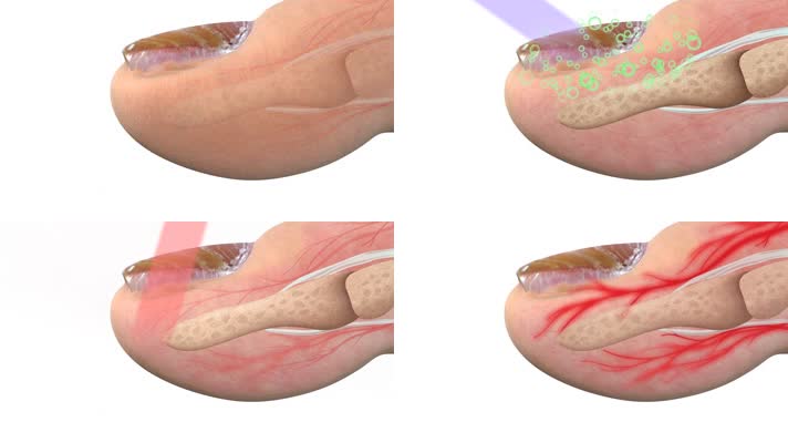 脚趾治疗灰指甲