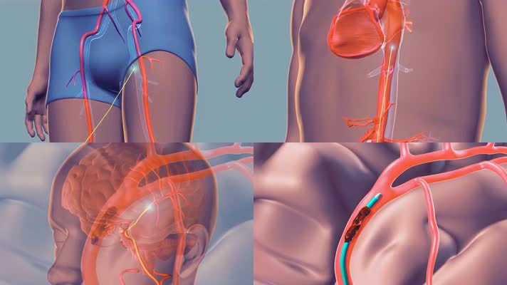 3D动画展示人体血管血栓清除全过程
