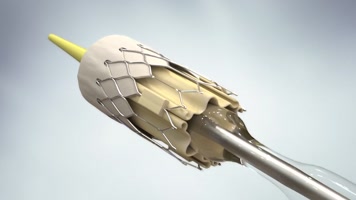 心脏搭桥手术 心脏搭桥手术