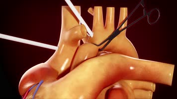 心脏移植的医学动画