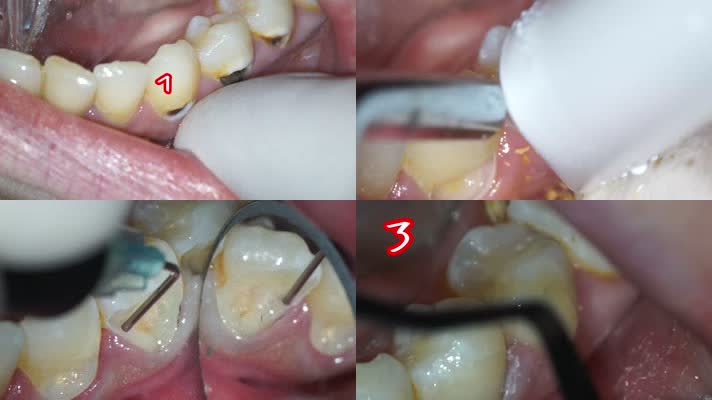 牙齿手术，蛀牙打磨填充