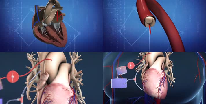 心脏瓣膜置换手术-人体