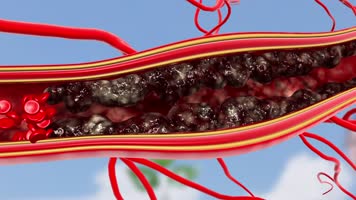 高血糖打通血管堵塞 高血糖打通血管堵塞