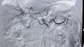 4K介入科反射做造影手术造影血管穿刺 4K介入科反射做造影手术造影血管穿刺