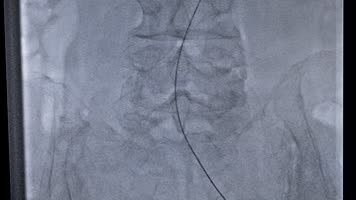 4K介入科反射做造影手术造影血管穿刺手术 4K介入科反射做造影手术造影血管穿刺手术