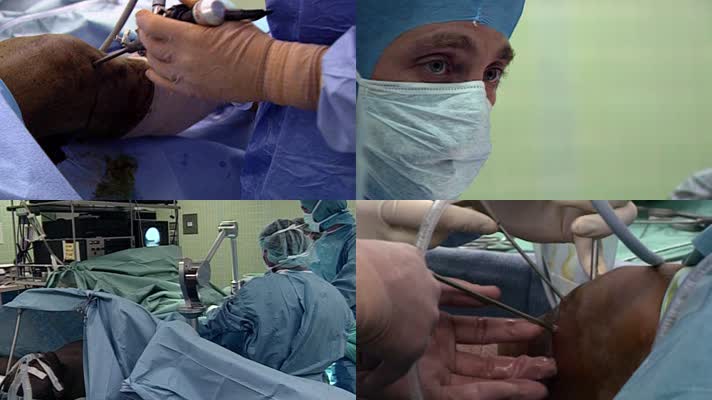 美国早期医院移植入更换人造关节器官手术