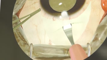 眼科手术 白内障眼球手术 医疗治疗