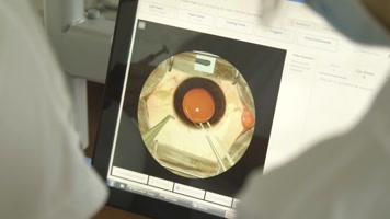 眼科手术 白内障手术界面 医疗治疗