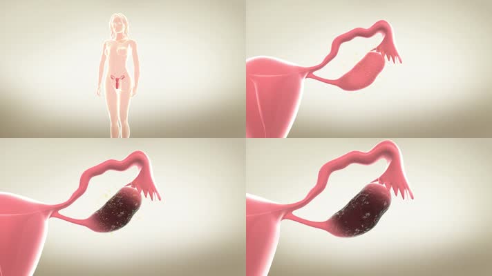 女性雌激素缺失导致卵巢萎缩
