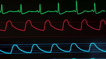 心跳监测心电图