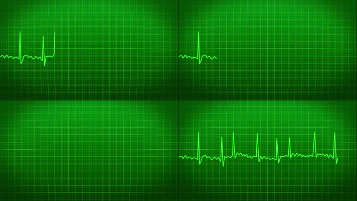 心电图波动心脏跳动医疗医学仪器动画 心电图波动心脏跳动医疗医学仪器动画